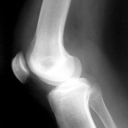 knee X-ray