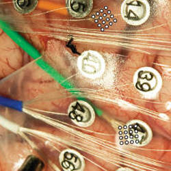electrodes atop a patient's brain