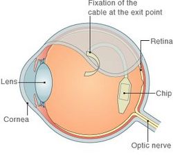 Retina implant