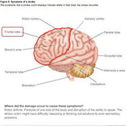 Interactive stroke symptoms