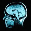 Measuring Metabolism Can Predict the Progress of Alzheimer's with 90 Percent Accuracy