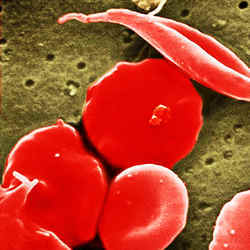 Standard and 'sickle' blood cells.