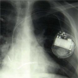 Implantable defibrillator