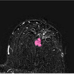 segmented lesion