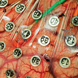 A sheet of electrodes picks up electrical activity from the surface of the brain.