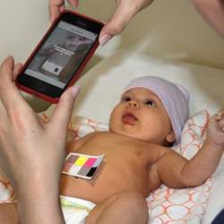Parents or physicians can monitor a newborn babys jaundice with their smartphones through BiliCam.