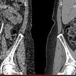 A look at a standard CT scan (left) versus an improved scan (right).