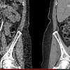 Fighting Lung Cancer: Faster Image Processing For Low-Radiation Ct Scans