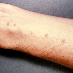 Skin blisters on the forearm, created by the entrance of Schistosoma parasite.