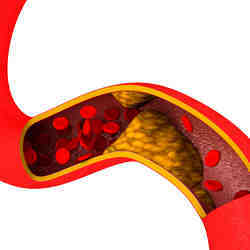 Artist's conception of how cholesterol can build up to create blockage in an artery.