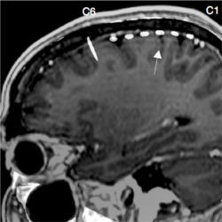 Deep brain stimulation