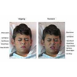 Examples of a childs facial expressions of pain from the study.