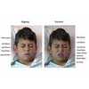 Staring Pain in the Face--Software 'reads' Kids' Expressions to Measure Pain Levels