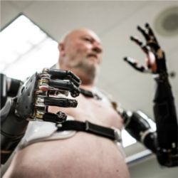 Prosthetic arm controlled by wearer's nerves