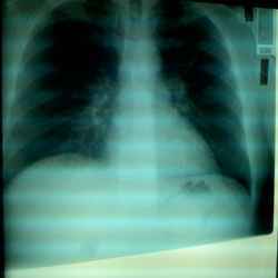 An x-ray of lungs.