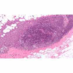 Micrograph showing a lymph node invaded by ductal breast carcinoma, with extension of the tumour beyond the lymph node. 