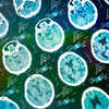 Predicting Change in the Alzheimer's Brain
