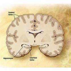 Diagram of the brain of a person with Alzheimer's Disease. 