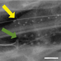 X-ray of co-implanted stentrode and epidural array