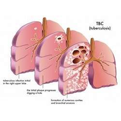 Lungs suffering from tuberculosis.