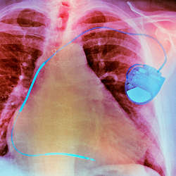 An implanted pacemaker.