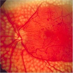 Scatter laser surgery for diabetic retinopathy