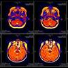 A Bug in Fmri Software Could Invalidate 15 Years of Brain Research