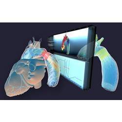 Simulation of the changes in blood flow after a virtual stent placement in a narrowing in the aorta.