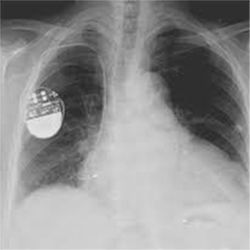 X-ray of thorax with pacemaker