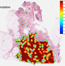 A deep-learning network was able to detect the presence of aggressive breast cancers; in many cases, it improved the delineated boundaries of tumors compared to those drawn by pathologists.