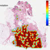 Computer Accurately Identifies and Delineates Breast Cancers on Digital Tissue Slides