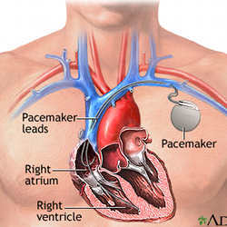 A pacemaker in use.