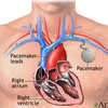 Pacemaker Recall Exposes National Need For Research and Education in Embedded Security