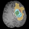 Scientists Enlist Supercomputers, Machine Learning to Automatically Identify Brain Tumors