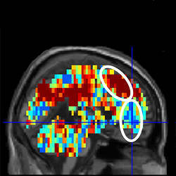 The brain activation pattern for "death" in study participants who had made a suicide attempt.