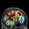Cmu, Pitt Brain Imaging Science Identifies Individuals With Suicidal Thoughts