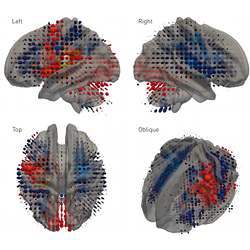 Represented as 3D cubic glyphs varying in color and scale are the weights of a transductive linear support vector machine classifier trained to relate the high-dimensional pattern of damage to gaze outcome. 