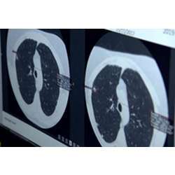 The system can give very early warning of lung cancer. 