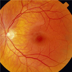 Retinal image