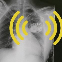 Cloud-connected pacemaker