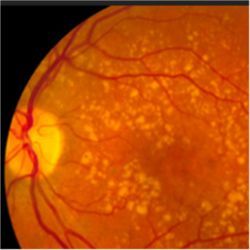 Retinal damage