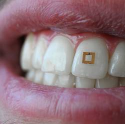 A miniaturized sensor mounted on a tooth.