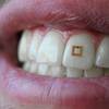 Scientists Develop Tooth-Mounted Sensors That Can Track What You Eat