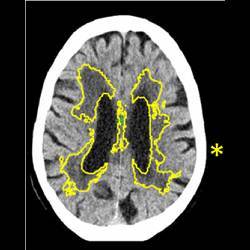 Identifying signs and severity of small vessel disease in a human brain scan.