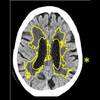 Artificial Intelligence Improves Stroke, Dementia Diagnoses in Brain Scans