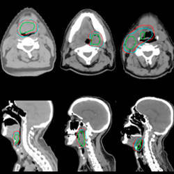 Comparison between computer-predicted ground-truth clinical target volume (blue) and physician manual contours (red) for three oropharyngeal cancer patients.