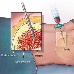 A standard bone marrow biopsy.