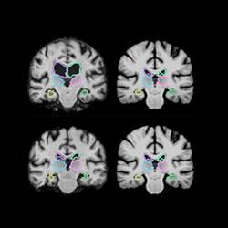 Identifying structures in brain scans.