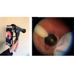 An ophthalmoscope attached to the lens of a smartphone (left), used to estimate the gestational age of newborns.