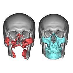 At left, a rendering of what a face looked like before surgery; at right, a planned rendering based on the donor's face.